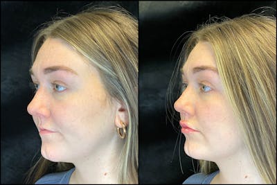 Dermal Fillers Before & After Gallery - Patient 103407100 - Image 1