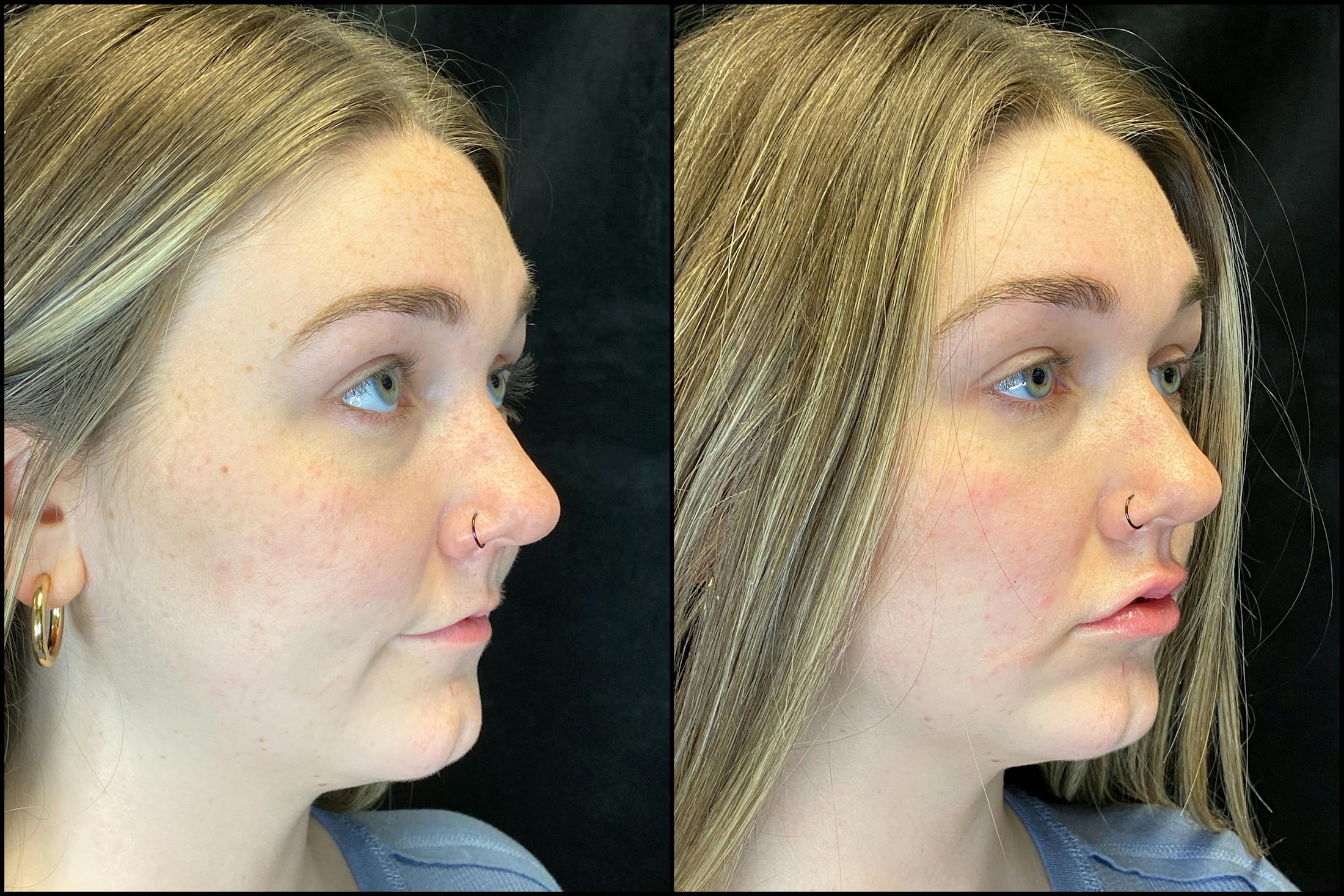 BOTOX/Dysport Before & After Gallery - Patient 120986666 - Image 2
