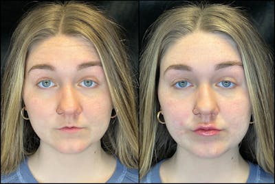 BOTOX/Dysport Before & After Gallery - Patient 120986666 - Image 1
