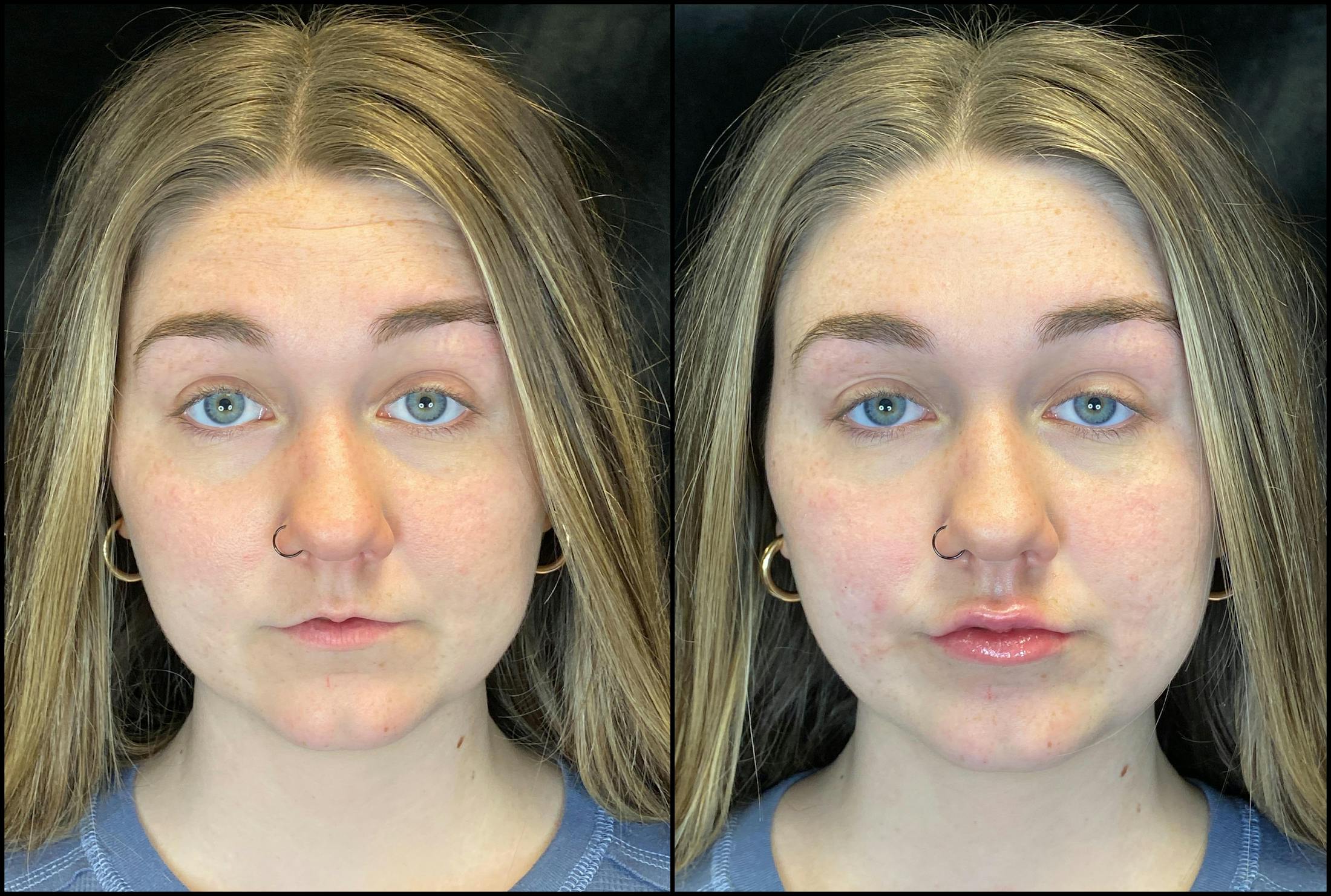 Dermal Fillers Before & After Gallery - Patient 103407100 - Image 3