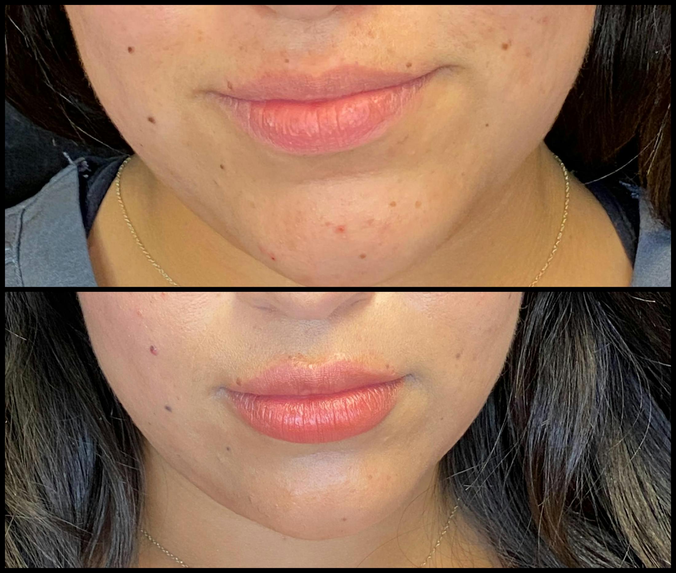 Dermal Fillers Before & After Gallery - Patient 79763244 - Image 2