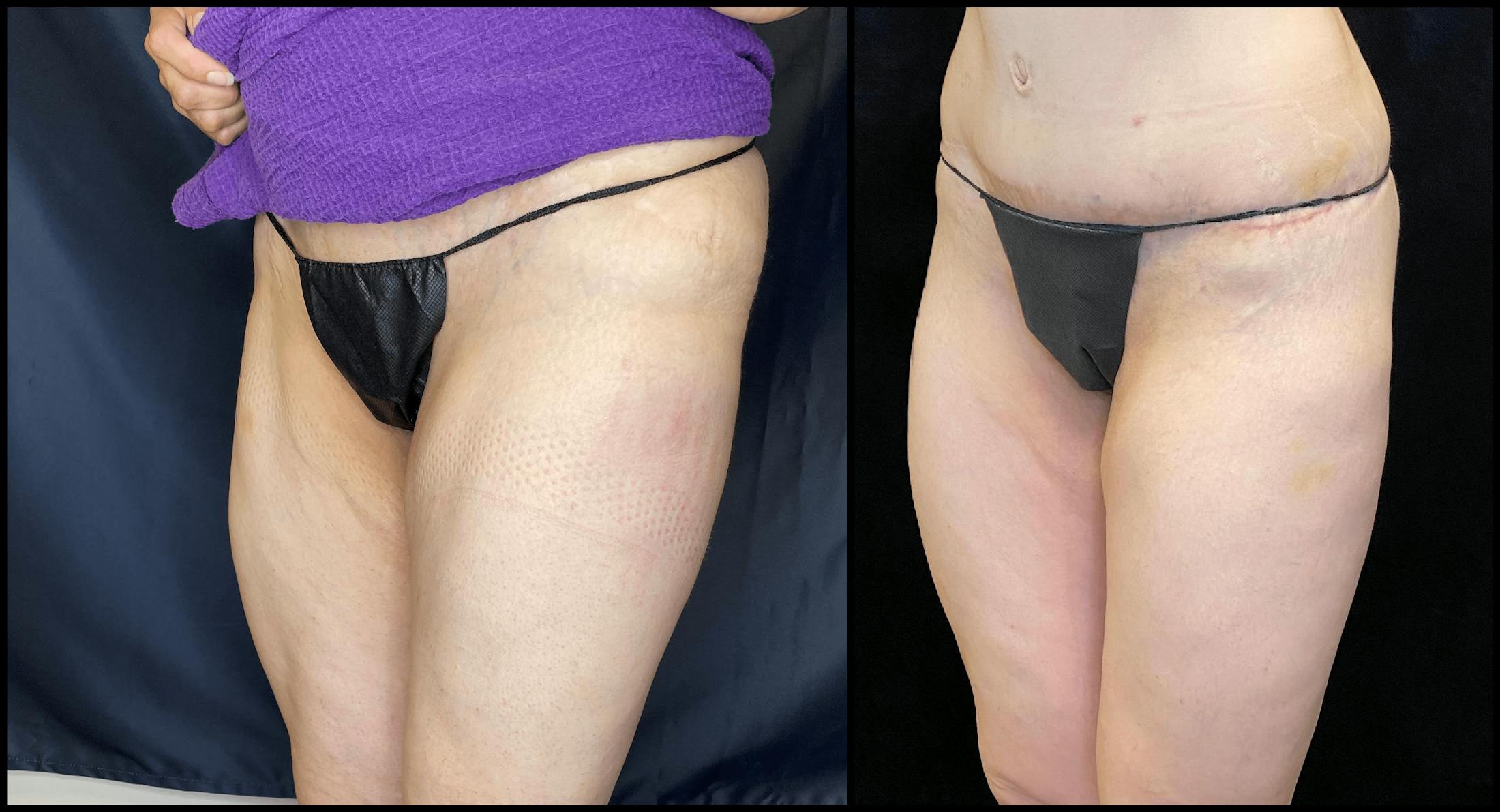 EvolveX Before & After Gallery - Patient 154143633 - Image 2