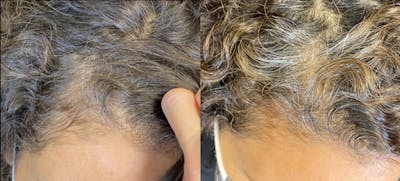 PRP Hair Restoration Before & After Gallery - Patient 154143464 - Image 1