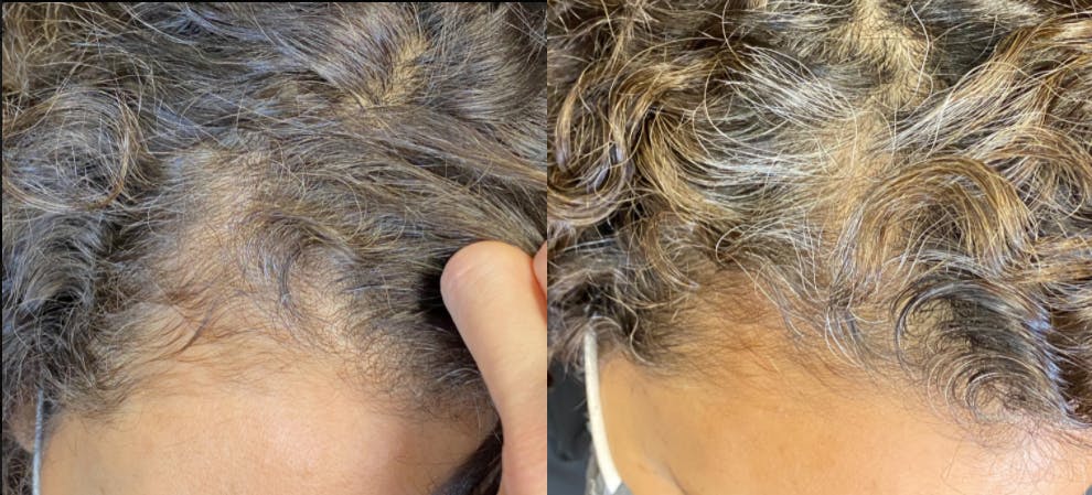 PRP Hair Restoration Before & After Gallery - Patient 154143464 - Image 1