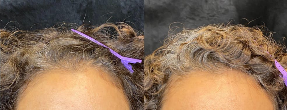 PRP Hair Restoration Before & After Gallery - Patient 154143464 - Image 2