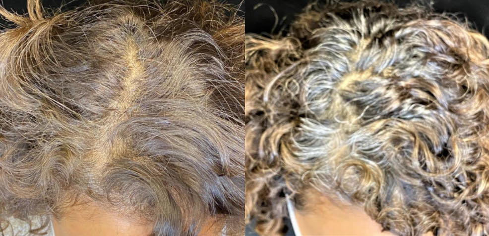 PRP Hair Restoration Before & After Gallery - Patient 154143464 - Image 3