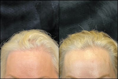 PRP Hair Restoration Before & After Gallery - Patient 154143465 - Image 1