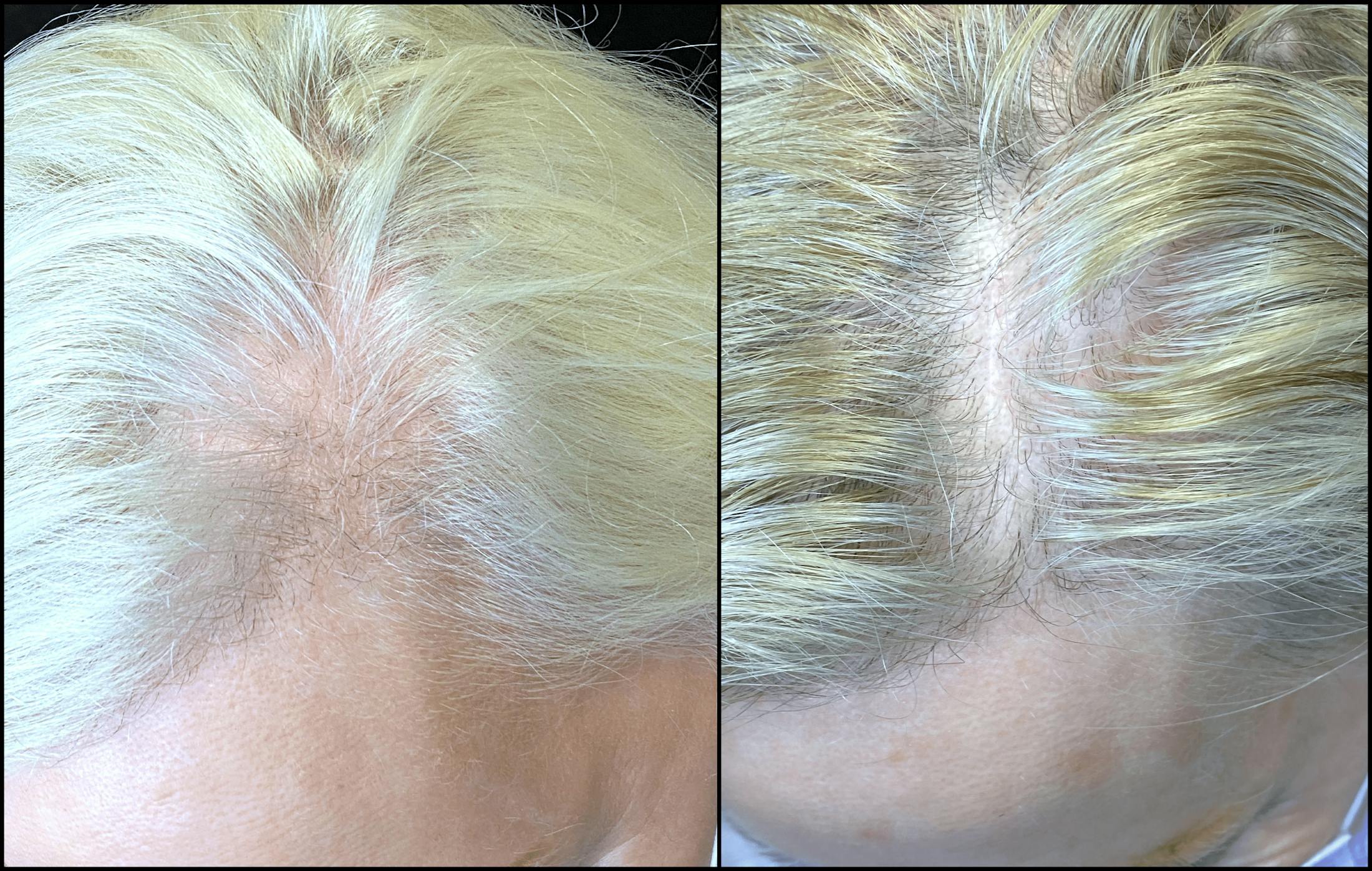PRP Hair Restoration Before & After Gallery - Patient 154143465 - Image 2