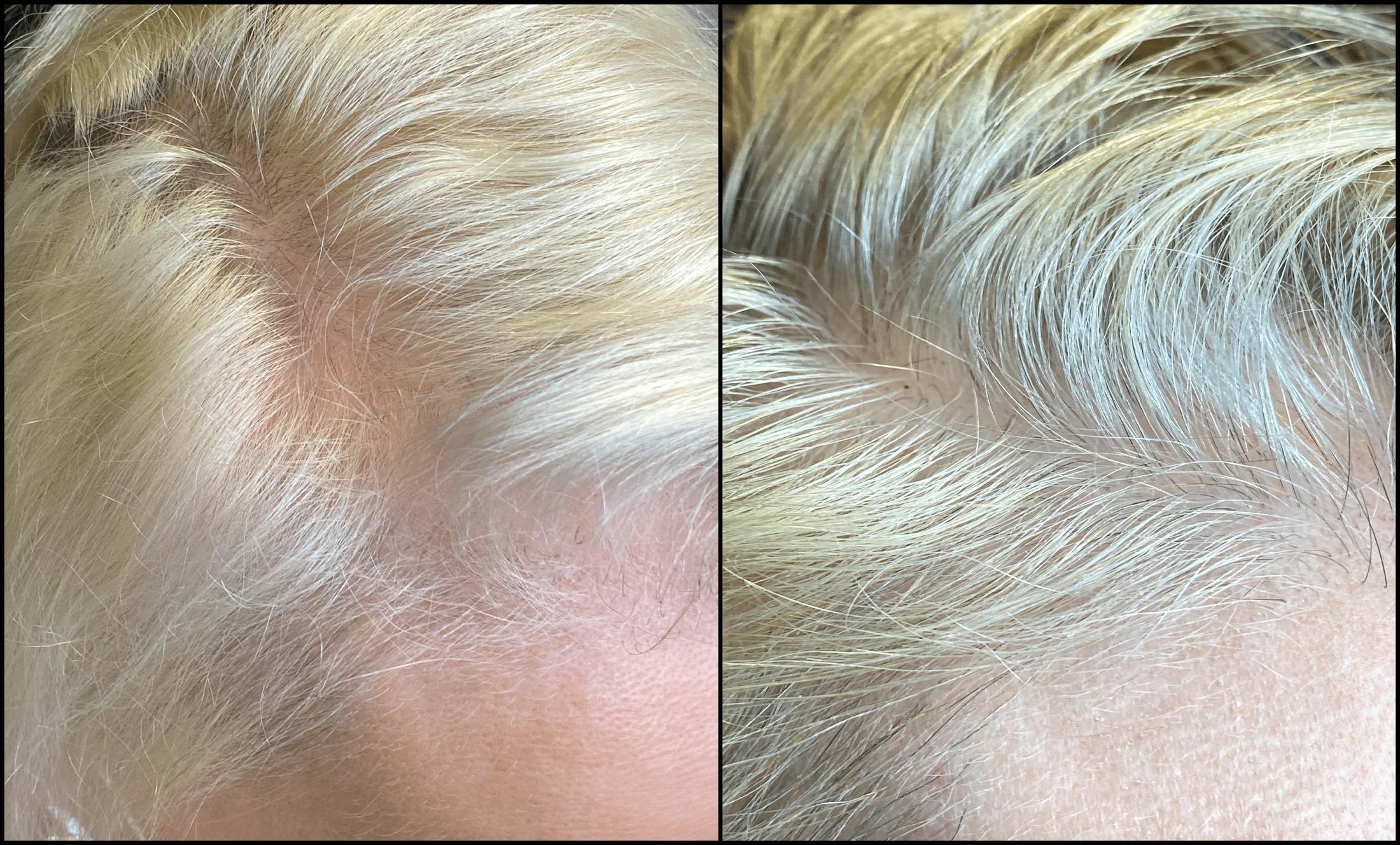 PRP Hair Restoration Before & After Gallery - Patient 154143465 - Image 3