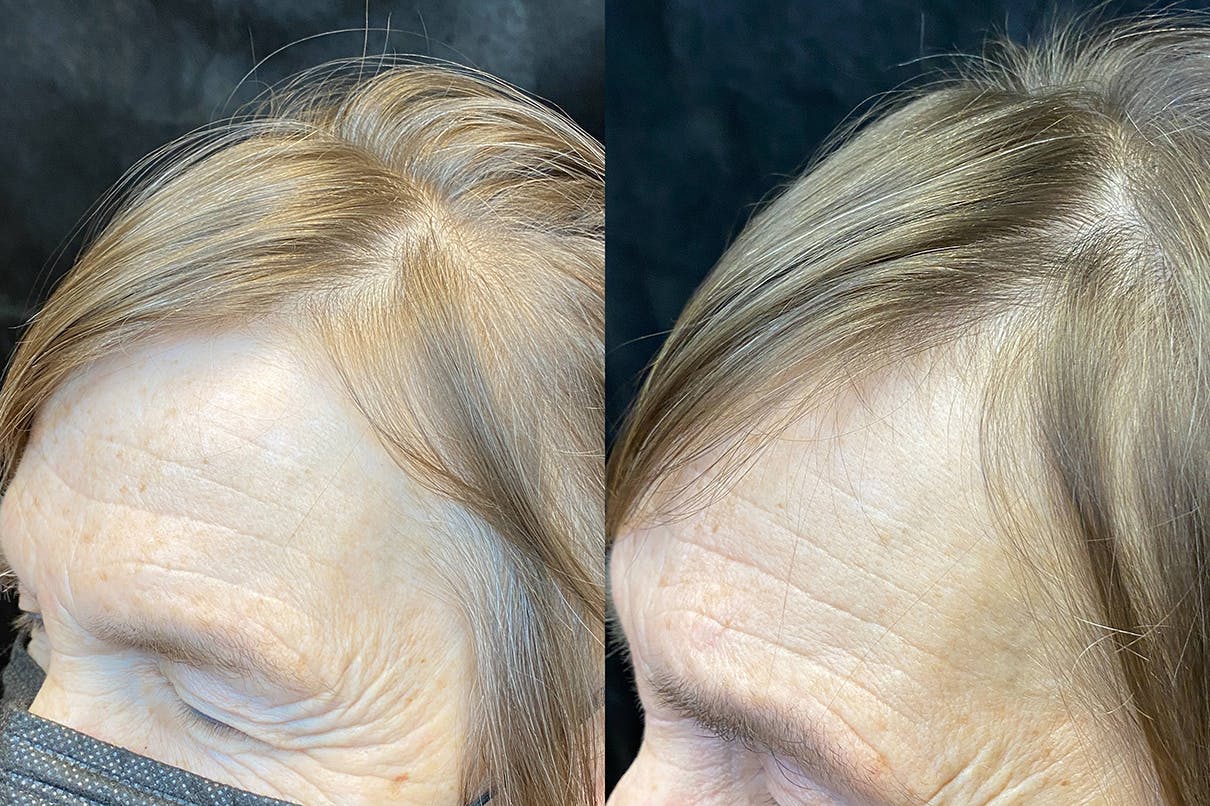 PRP Hair Restoration Before & After Gallery - Patient 233415 - Image 2