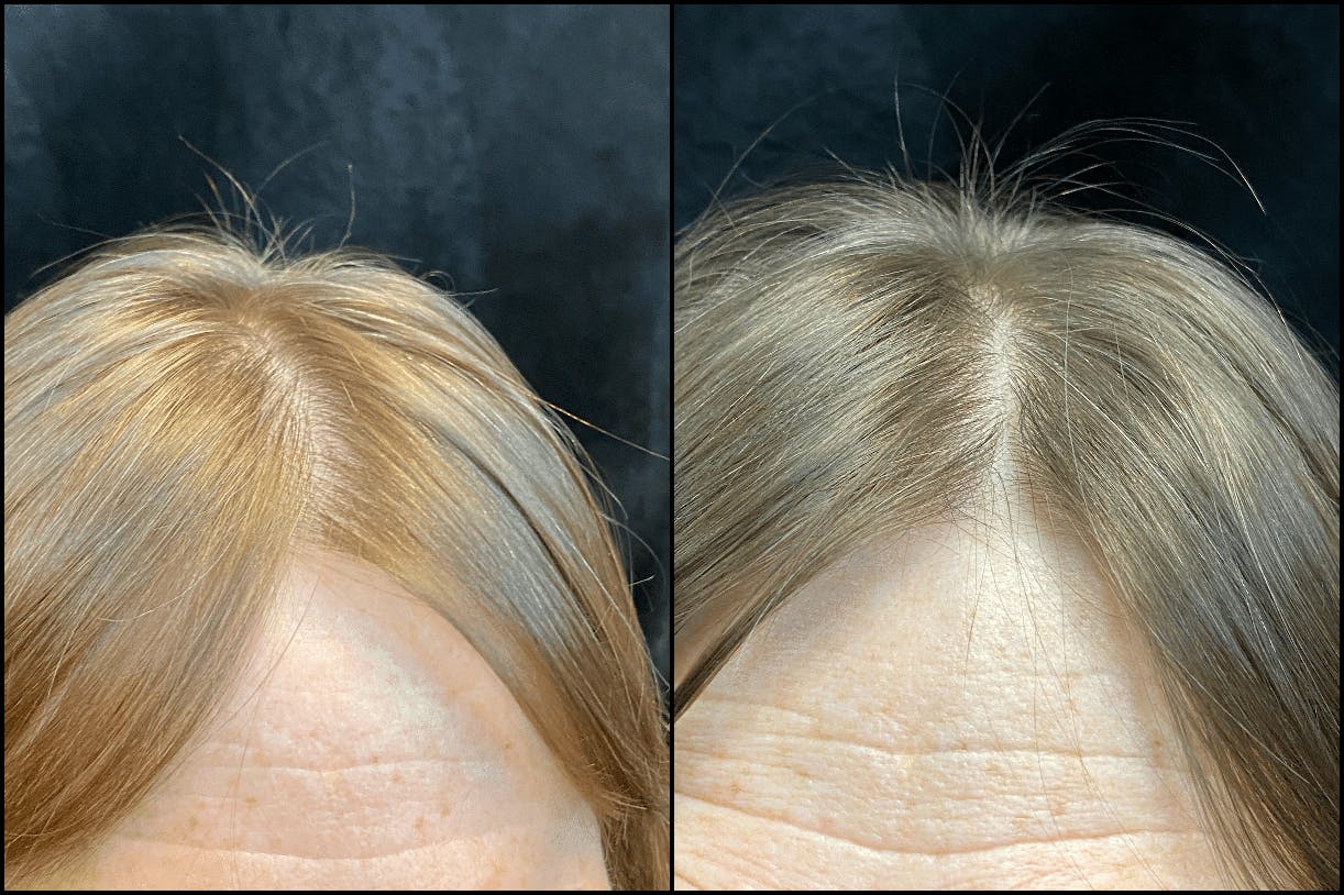 PRP Hair Restoration Before & After Gallery - Patient 233415 - Image 1