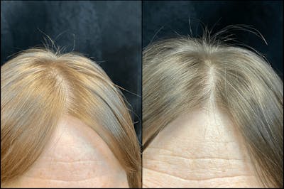 PRP Hair Restoration Before & After Gallery - Patient 154143470 - Image 1