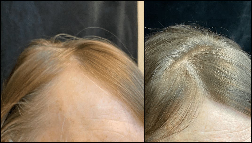 PRP Hair Restoration Before & After Gallery - Patient 233415 - Image 3