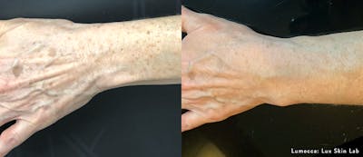 Lumecca Before & After Gallery - Patient 106987025 - Image 1