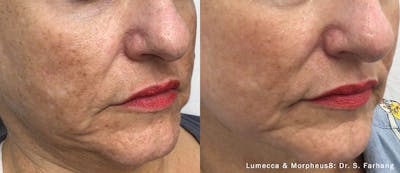 IPL Photofacial with Lumecca Before & After Gallery - Patient 106987071 - Image 1