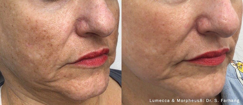 IPL Photofacial with Lumecca Before & After Gallery - Patient 106987071 - Image 1