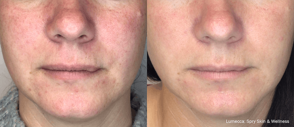 IPL for Face Before & After Gallery - Patient 106987072 - Image 1