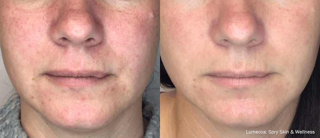 IPL Photofacial with Lumecca Before & After Gallery - Patient 106987072 - Image 1