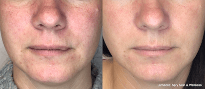 IPL for Face Before & After Gallery - Patient 106987072 - Image 1