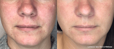 IPL Photofacial with Lumecca Before & After Gallery - Patient 106987072 - Image 1