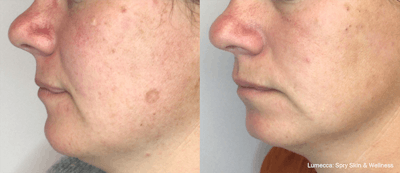 IPL for Face Before & After Gallery - Patient 106987073 - Image 1