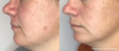 IPL Photofacial with Lumecca Before & After Gallery - Patient 106987073 - Image 1