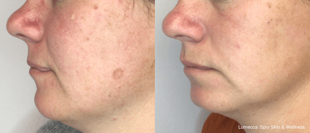 IPL Photofacial with Lumecca Before & After Gallery - Patient 106987073 - Image 1