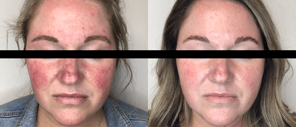 IPL for Face Before & After Gallery - Patient 106987074 - Image 1