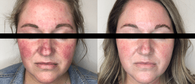 IPL Photofacial with Lumecca Before & After Gallery - Patient 106987074 - Image 1