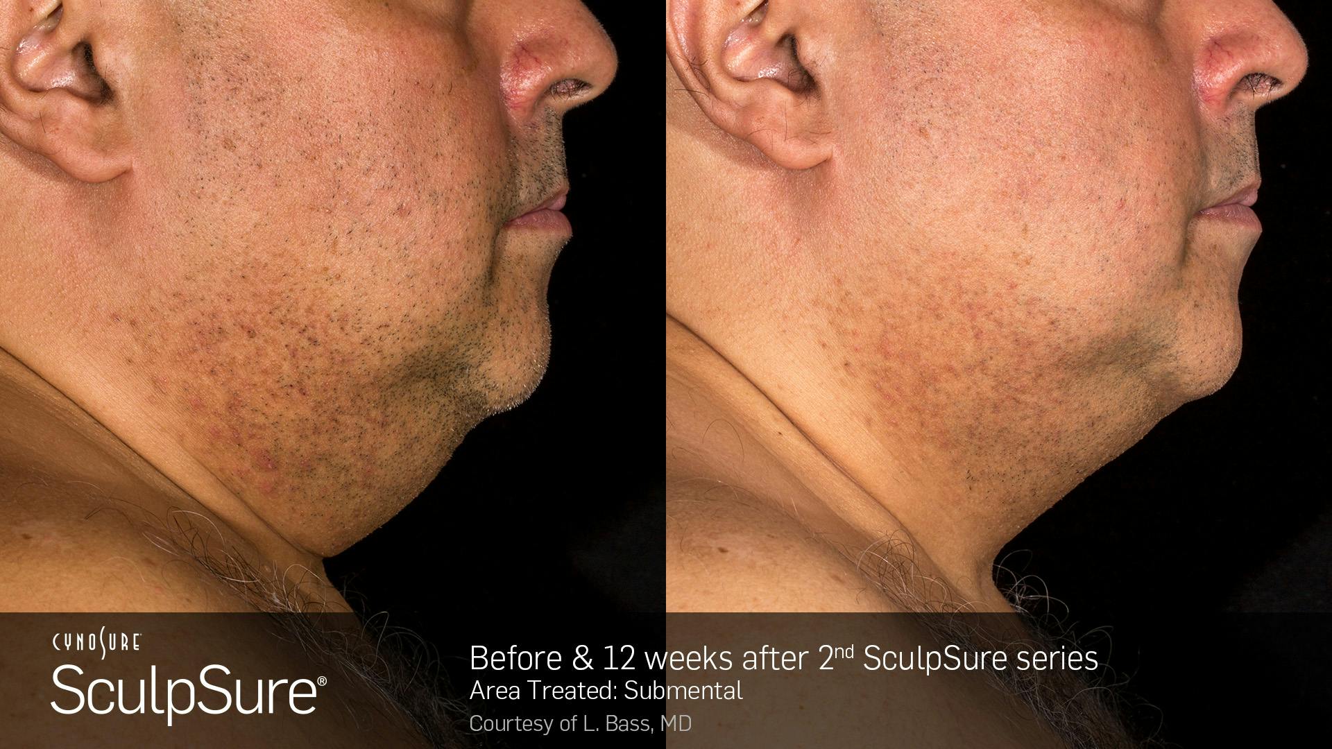 SculpSure Before & After Gallery - Patient 106997312 - Image 1