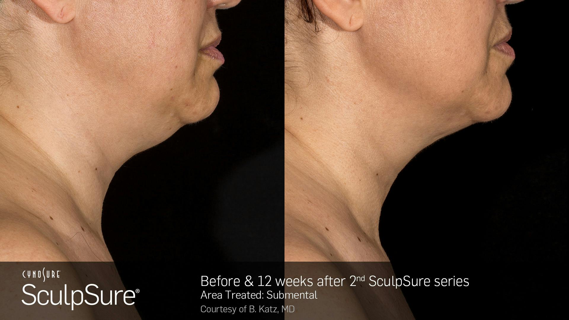 SculpSure Before & After Gallery - Patient 106997313 - Image 1