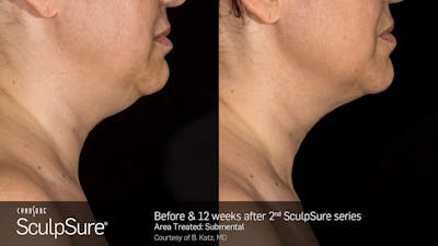 SculpSure Before & After Gallery - Patient 106997313 - Image 1