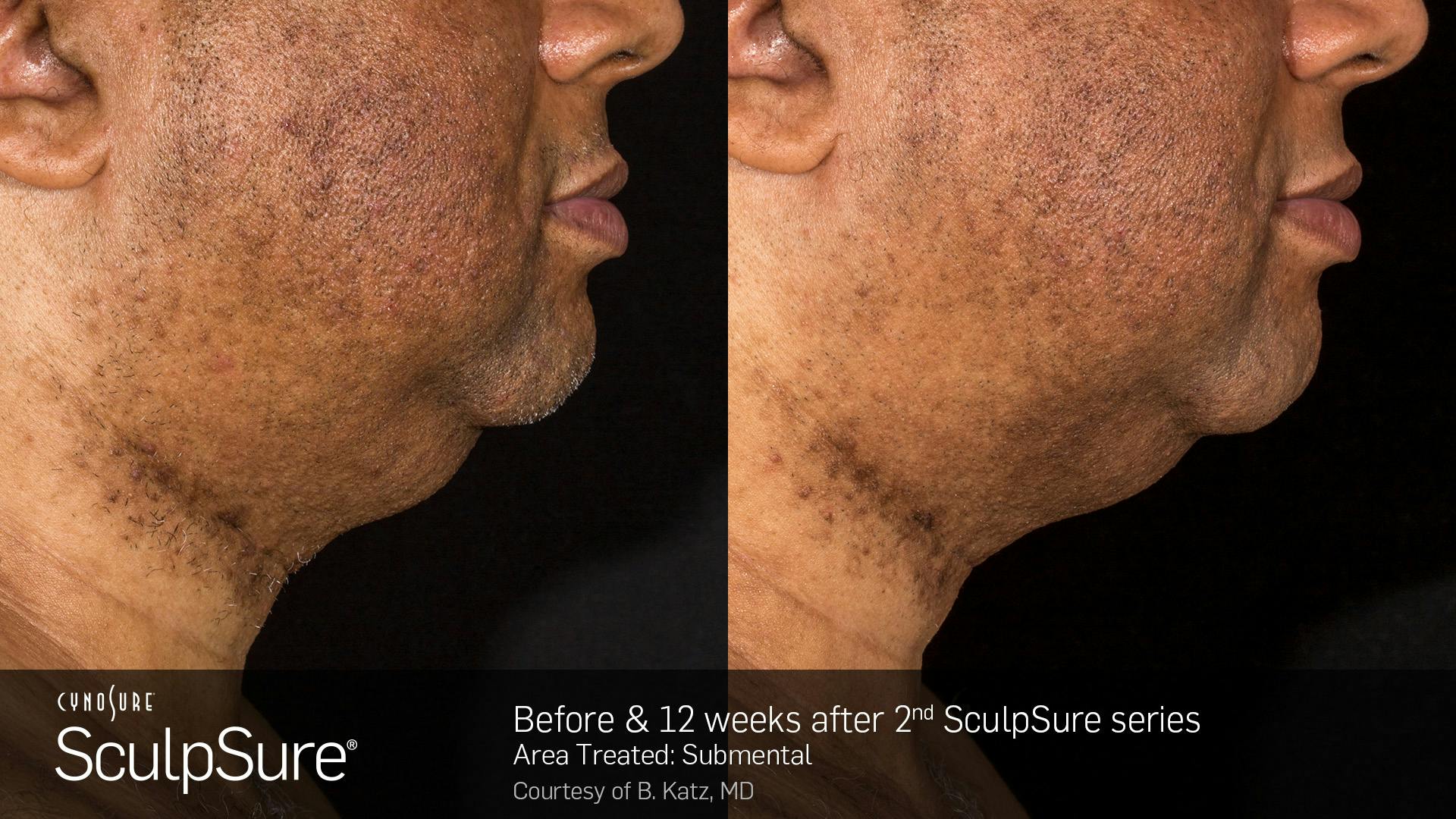 SculpSure Before & After Gallery - Patient 106997314 - Image 1