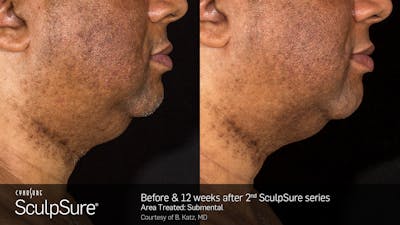 SculpSure Before & After Gallery - Patient 106997314 - Image 1