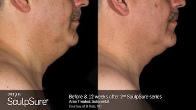 SculpSure Before & After Gallery - Patient 106997315 - Image 1