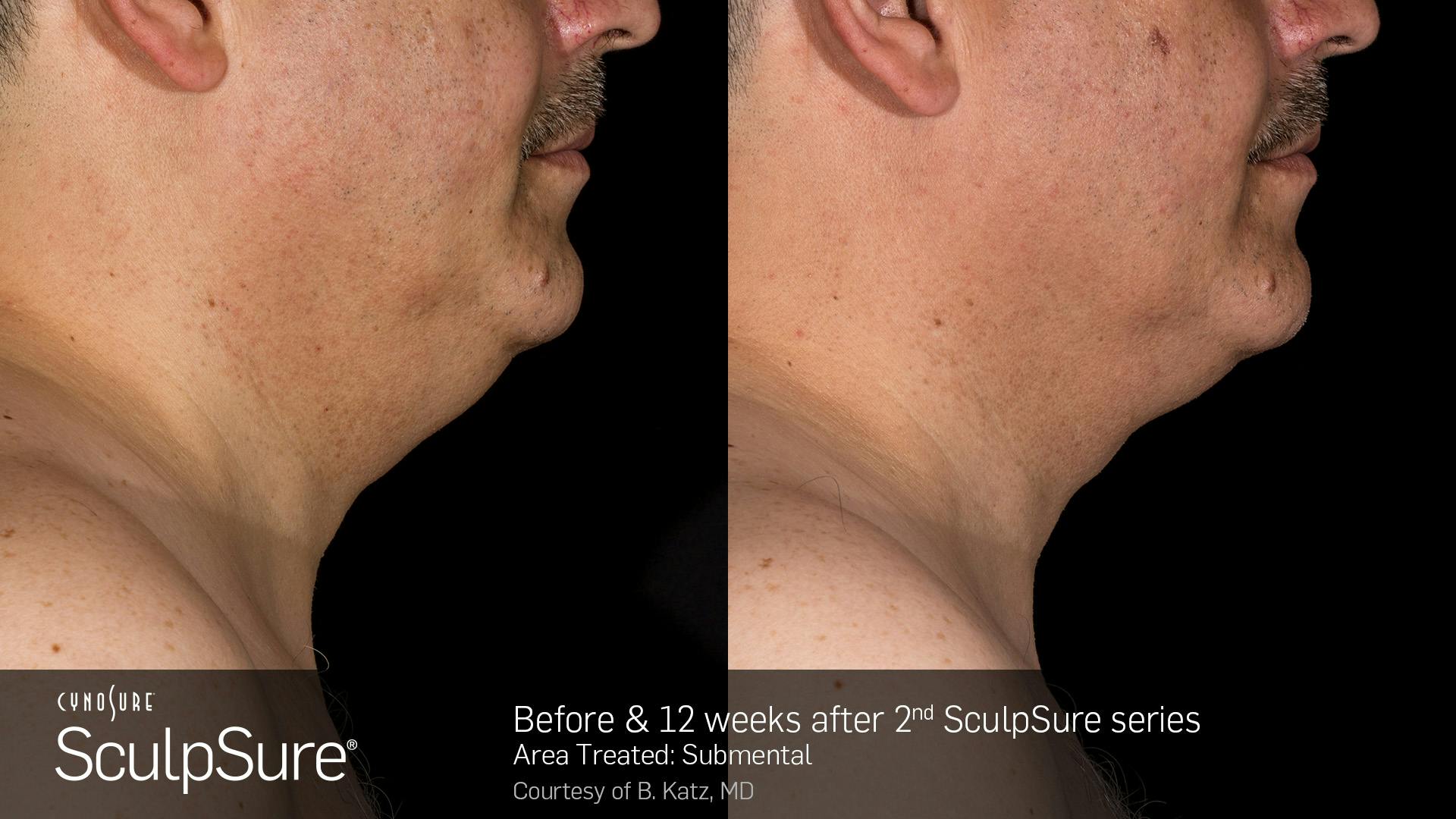 SculpSure Before & After Gallery - Patient 106997315 - Image 1