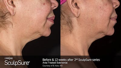 SculpSure Before & After Gallery - Patient 106997317 - Image 1
