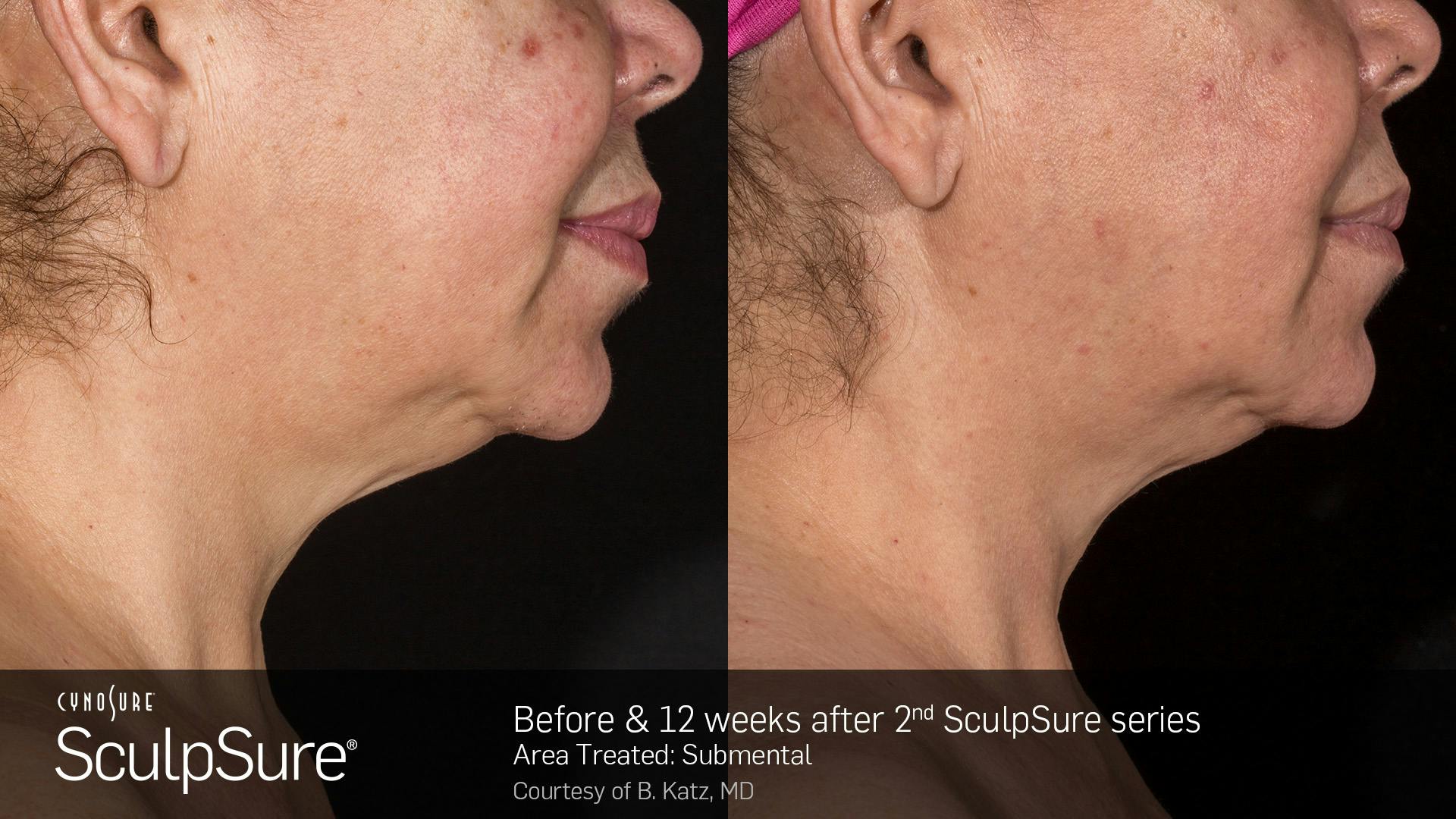 SculpSure Before & After Gallery - Patient 106997317 - Image 1