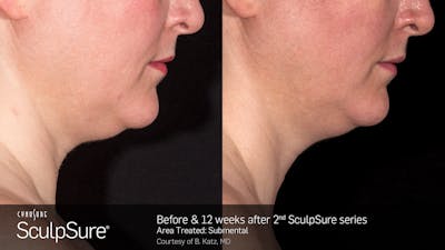 SculpSure Before & After Gallery - Patient 106997318 - Image 1