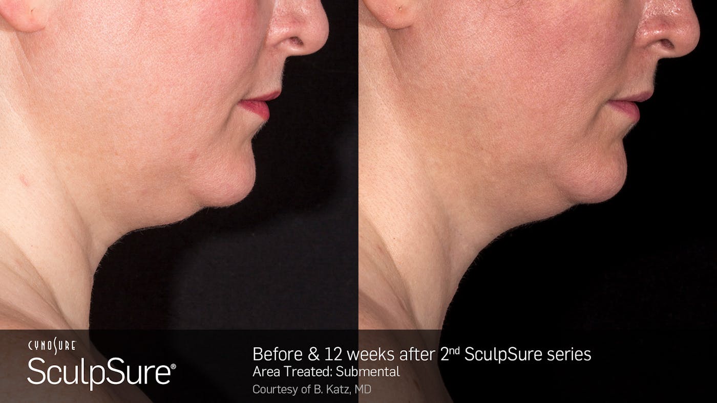 Before and after SculpSure at Modern Women's Health