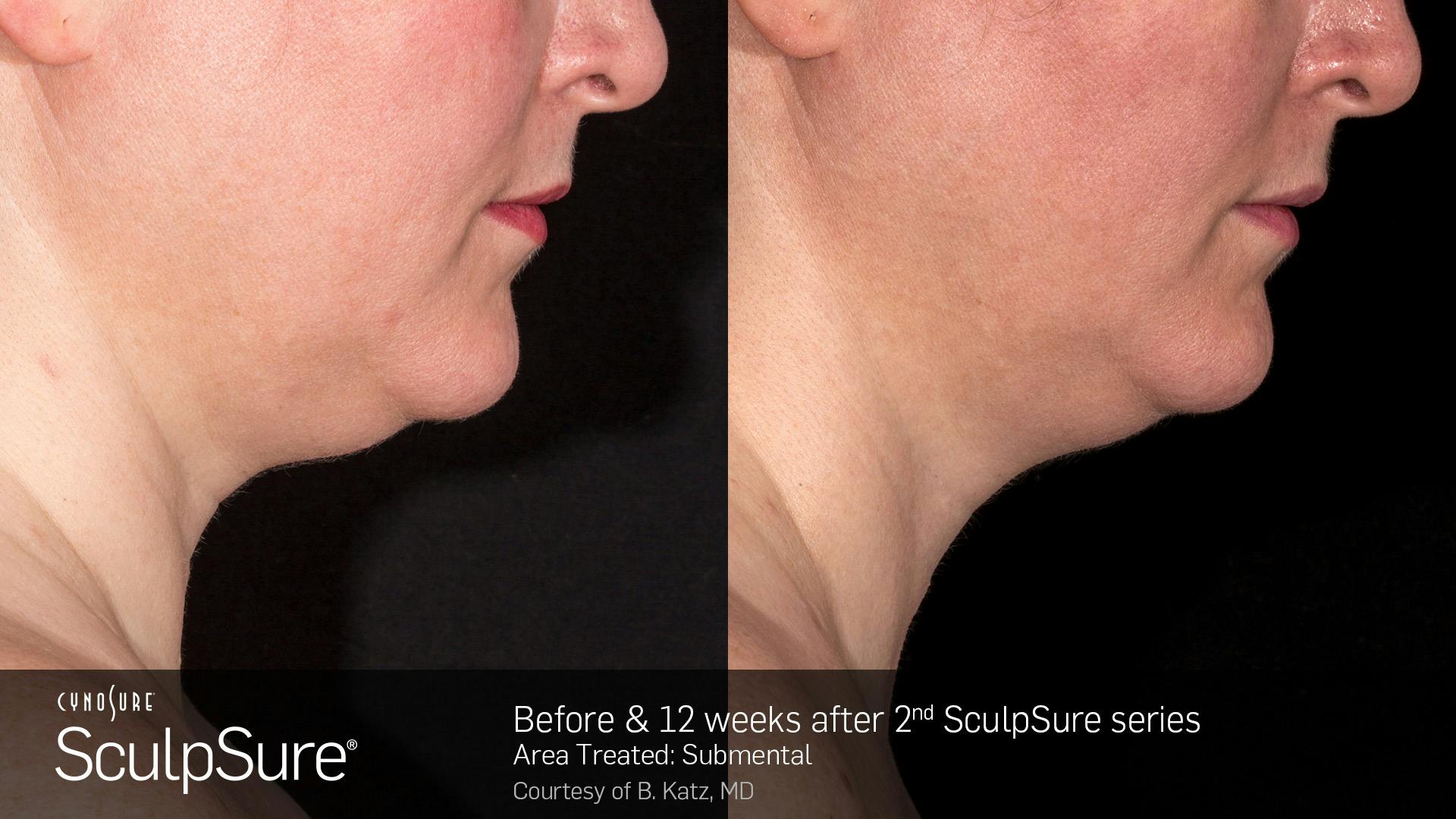 SculpSure Before & After Gallery - Patient 106997318 - Image 1
