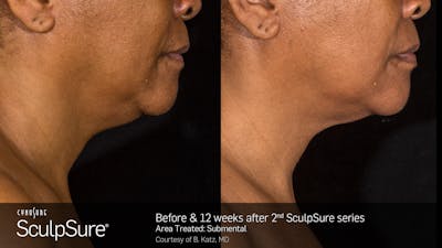 SculpSure Before & After Gallery - Patient 106997319 - Image 1