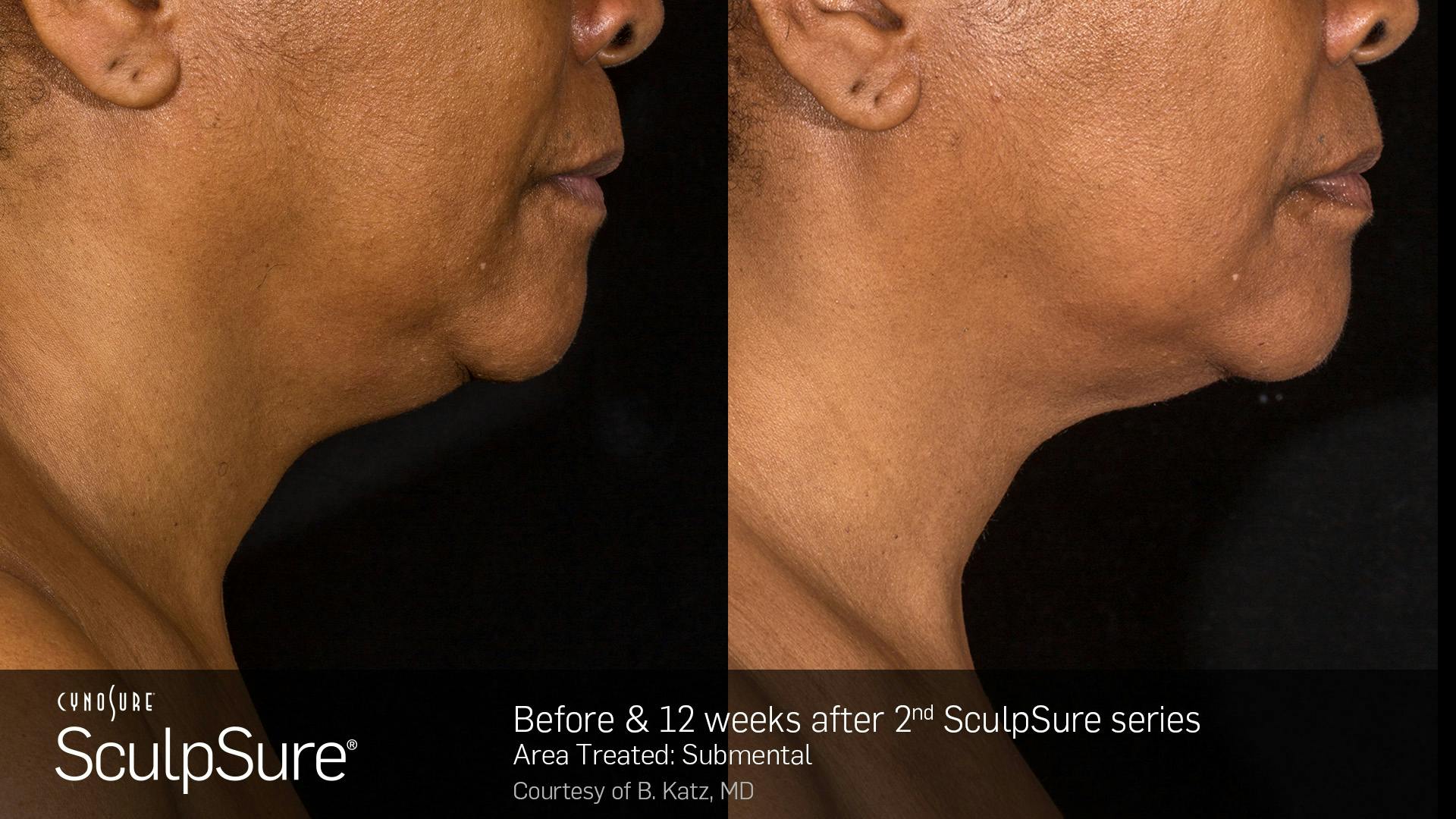 SculpSure Before & After Gallery - Patient 106997319 - Image 1