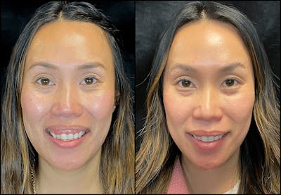 BOTOX/Dysport Before & After Gallery - Patient 119930581 - Image 1