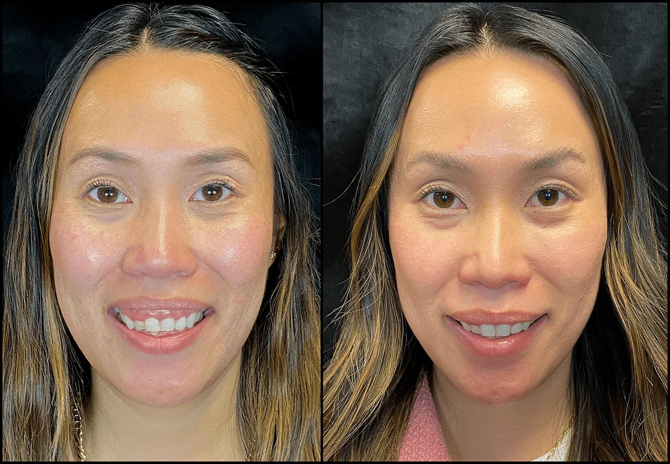 BOTOX/Dysport Before & After Gallery - Patient 119930581 - Image 1