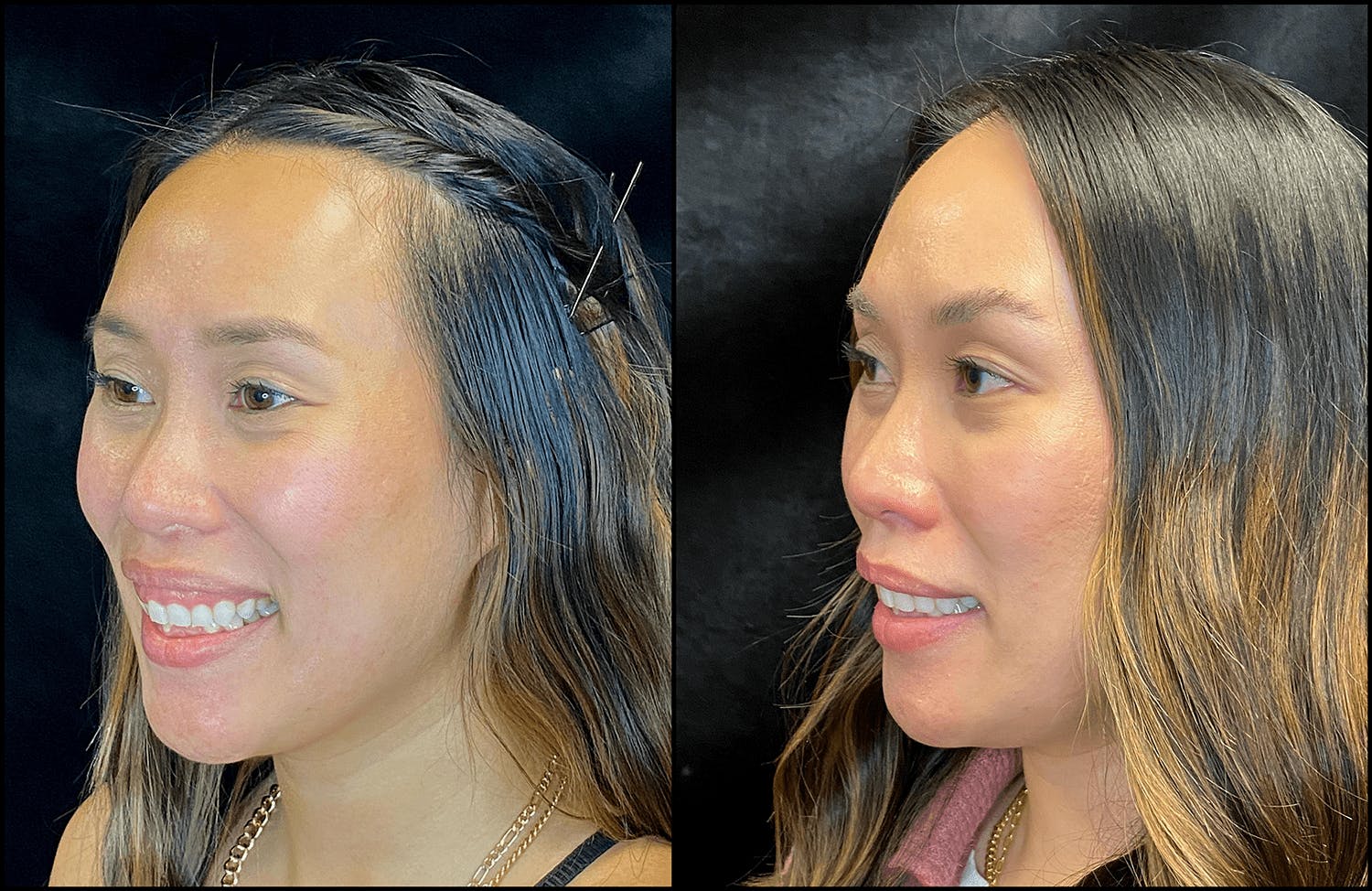 BOTOX/Dysport Before & After Gallery - Patient 119930581 - Image 2