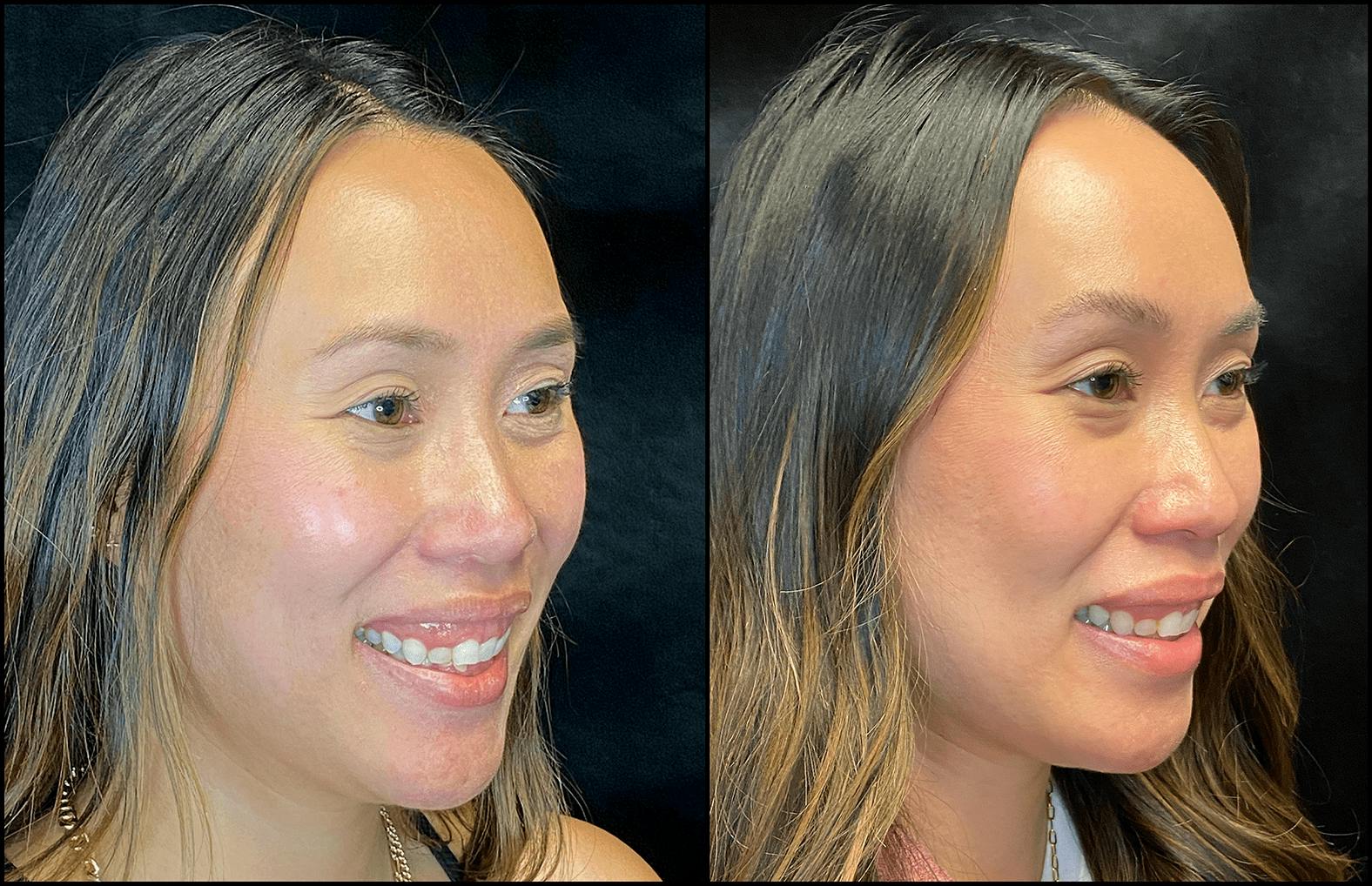 BOTOX/Dysport Before & After Gallery - Patient 119930581 - Image 3