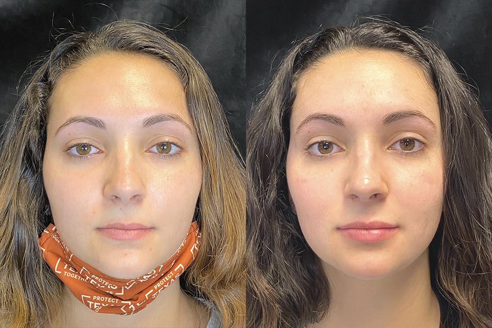 Dermal Fillers Before & After Gallery - Patient 120816839 - Image 1