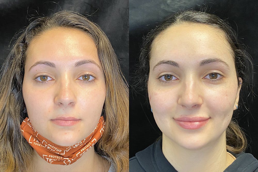 Dermal Fillers Before & After Gallery - Patient 120816839 - Image 2