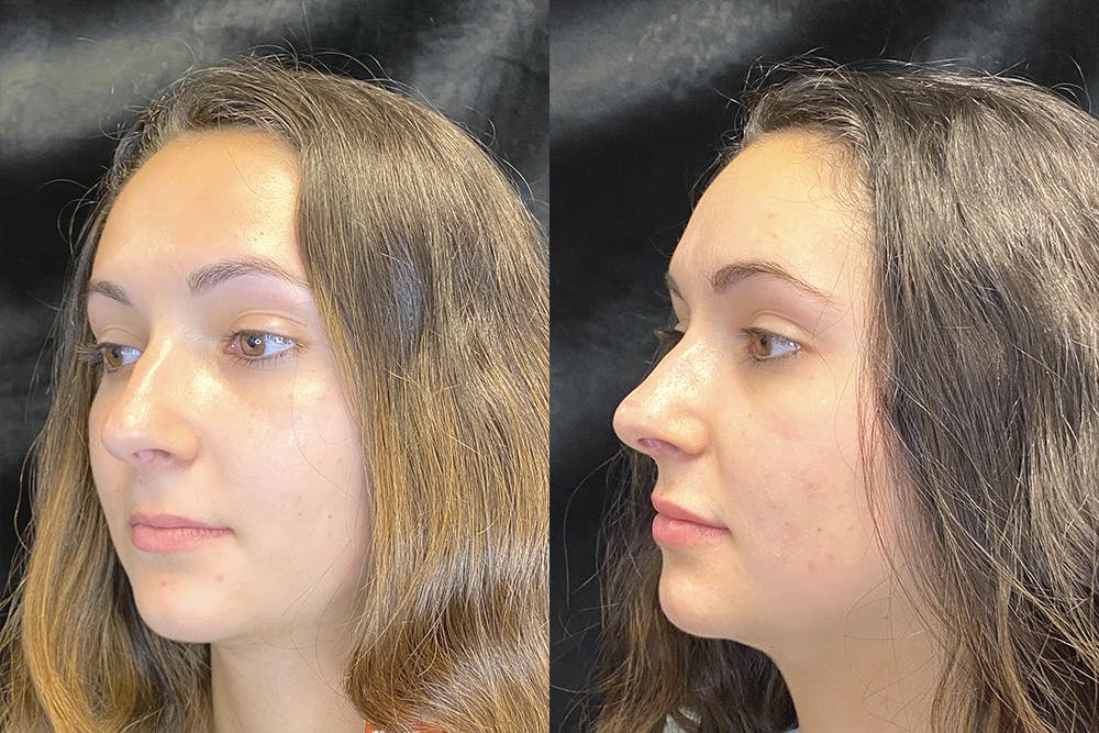 Dermal Fillers Before & After Gallery - Patient 120816839 - Image 3